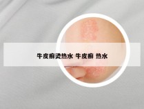 牛皮癣烫热水 牛皮癣 热水