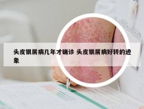 头皮银屑病几年才确诊 头皮银屑病好转的迹象