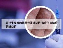 治疗牛皮癣的最新特效进口药 治疗牛皮肤癣的进口药