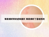 银屑病好转的迹象图片 银屑病好了是啥样的