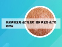 银屑病照紫外线灯后发红 银屑病紫外线灯照射时间