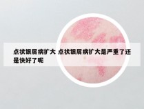 点状银屑病扩大 点状银屑病扩大是严重了还是快好了呢