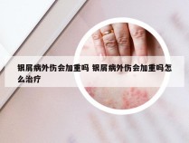 银屑病外伤会加重吗 银屑病外伤会加重吗怎么治疗