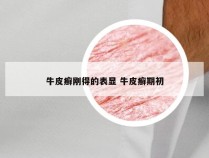 牛皮癣刚得的表显 牛皮癣期初
