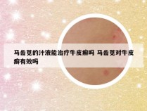 马齿苋的汁液能治疗牛皮癣吗 马齿苋对牛皮癣有效吗