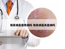 银屑病是菌类病吗 银屑病是真菌病吗