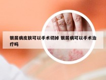 银屑病皮肤可以手术切掉 银屑病可以手术治疗吗