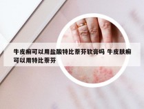 牛皮癣可以用盐酸特比萘芬软膏吗 牛皮肤癣可以用特比萘芬