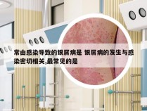 常由感染导致的银屑病是 银屑病的发生与感染密切相关,最常见的是