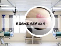 银屑病帝王 银屑病病友吧
