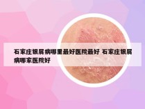 石家庄银屑病哪里最好医院最好 石家庄银屑病哪家医院好