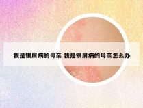 我是银屑病的母亲 我是银屑病的母亲怎么办