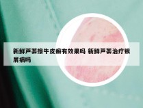 新鲜芦荟擦牛皮癣有效果吗 新鲜芦荟治疗银屑病吗