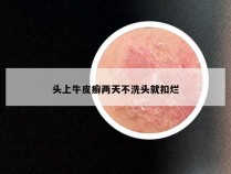 头上牛皮癣两天不洗头就扣烂
