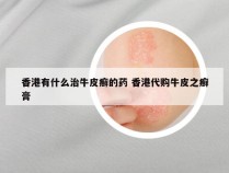 香港有什么治牛皮癣的药 香港代购牛皮之癣膏