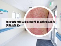 银屑病要擦维生素e软膏吗 银屑病可以抹点天然维生素e