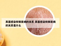 真菌感染和银屑病的关系 真菌感染和银屑病的关系是什么