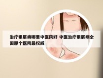 治疗银屑病哪里中医院好 中医治疗银屑病全国那个医院最权威