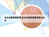 女儿头部有银屑病 女儿头部有银屑病怎么治疗
