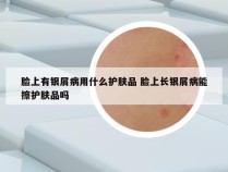 脸上有银屑病用什么护肤品 脸上长银屑病能擦护肤品吗
