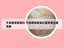 牛皮癣皮肤变红 牛皮癣皮肤变红是恢复还是发展