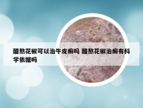 醋熬花椒可以治牛皮癣吗 醋熬花椒治癣有科学依据吗