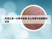 头顶上有一小块牛皮癣 头上出现牛皮肤癣怎么办