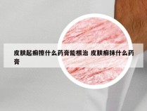 皮肤起癣擦什么药膏能根治 皮肤癣抹什么药膏