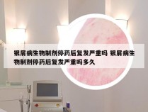 银屑病生物制剂停药后复发严重吗 银屑病生物制剂停药后复发严重吗多久