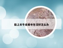 脸上长牛皮癣半年没好怎么办