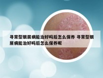 寻常型银屑病能治好吗后怎么保养 寻常型银屑病能治好吗后怎么保养呢