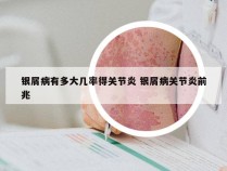 银屑病有多大几率得关节炎 银屑病关节炎前兆