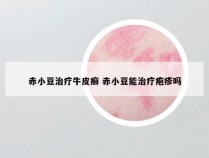 赤小豆治疗牛皮癣 赤小豆能治疗疱疹吗