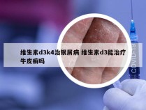维生素d3k4治银屑病 维生素d3能治疗牛皮癣吗