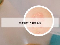 牛皮癣好了斑怎么去