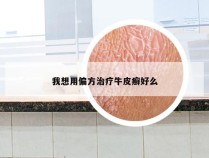 我想用偏方治疗牛皮癣好么