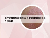 治疗寻常型银屑病的药 寻常型银屑病用什么外用药好