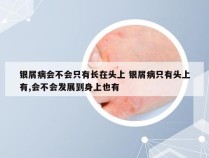 银屑病会不会只有长在头上 银屑病只有头上有,会不会发展到身上也有