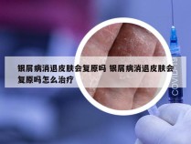 银屑病消退皮肤会复原吗 银屑病消退皮肤会复原吗怎么治疗