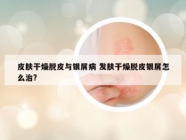 皮肤干燥脱皮与银屑病 发肤干燥脱皮银屑怎么治?