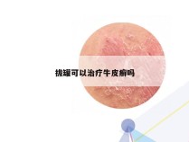 拔罐可以治疗牛皮癣吗