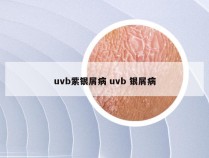 uvb紫银屑病 uvb 银屑病