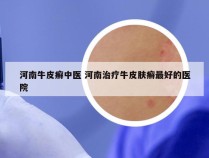 河南牛皮癣中医 河南治疗牛皮肤癣最好的医院