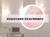 灵芝能治牛皮癣吗 灵芝治疗银屑病药方