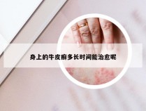 身上的牛皮癣多长时间能治愈呢