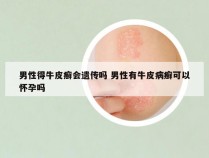 男性得牛皮癣会遗传吗 男性有牛皮病癣可以怀孕吗