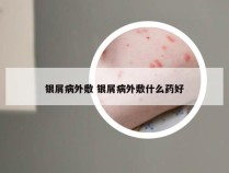 银屑病外敷 银屑病外敷什么药好