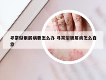 寻常型银屑病要怎么办 寻常型银屑病怎么自愈