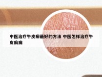 中医治疗牛皮癣最好的方法 中医怎样治疗牛皮癣病