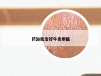 药浴能治好牛皮癣能